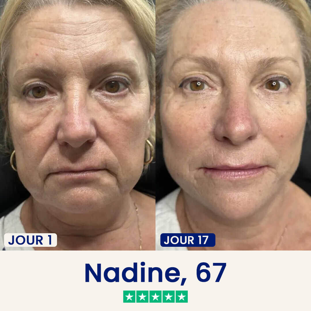 Minceor Lift : Réduit votre double menton sans effort