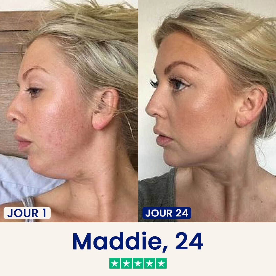 Minceor Lift : Réduit votre double menton sans effort