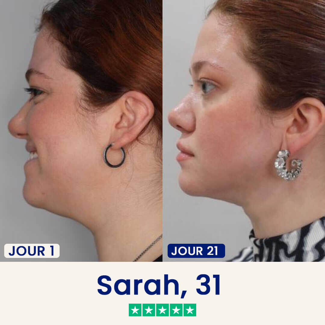 Minceor Lift : Réduit votre double menton sans effort