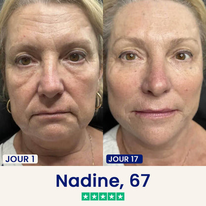 Minceor Lift : Réduit votre double menton sans effort